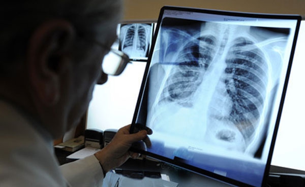 17 сентября в Краматорске врачи ответят на вопросы по туберкулезу