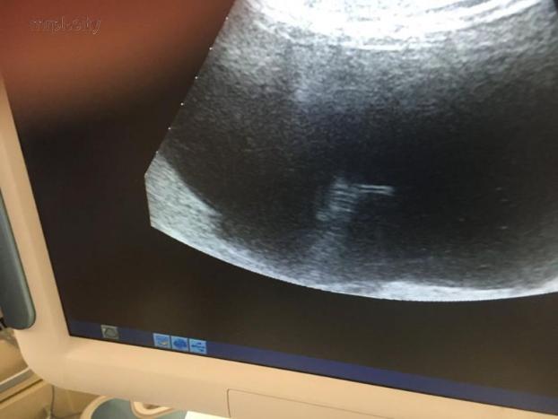 Мариупольские медики провели уникальную операцию и спасли беременную
