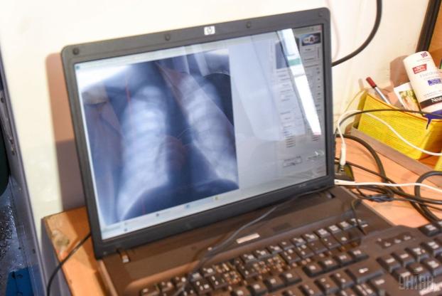 Украинцев предупредили, при каких симптомах туберкулеза надо идти к врачу