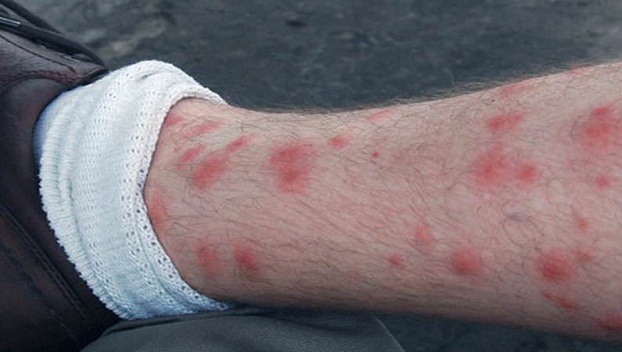 Молодой австралиец пострадал от активности плотоядных насекомых