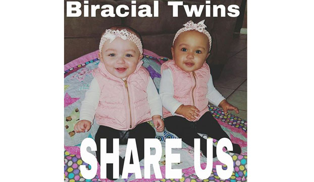  В Америке близнецы родились с разным цветом кожи