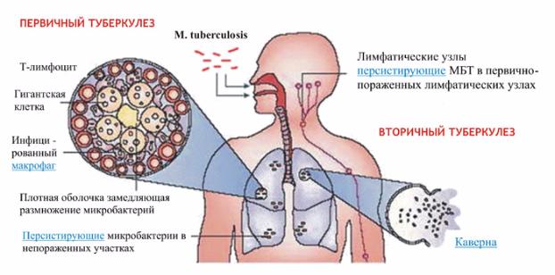 Здравоохранение: В Дружковке объявили «войну» туберкулезу
