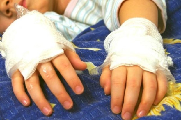 В Бахмуте при пожаре пострадал 12-летний ребенок