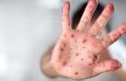 More than 80 cases of measles were recorded over the last week in the Donetsk region