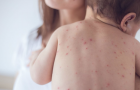 How many Ukrainians have had measles since the beginning of 2019?