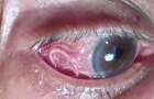 Врачи извлекли из глаза мужчины 15-сантиметрового червя-паразита