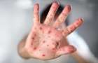 Over the week two people got sick with measles in Kramatorsk