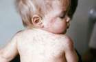 There are new measles cases in Mariupol